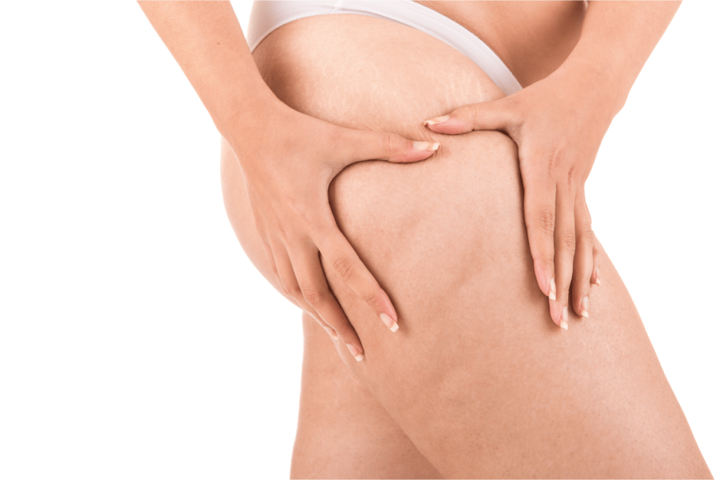 Dicas para remover a celulite com remédios naturais